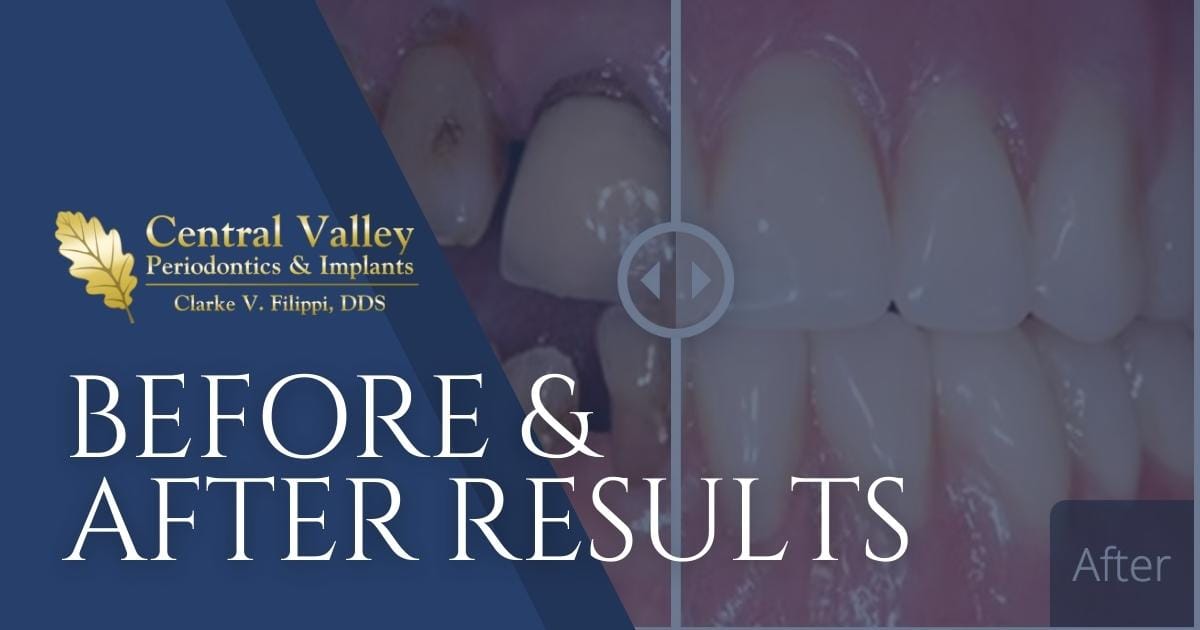 before-after-results-modesto-ca-clarke-v-filippi-dds